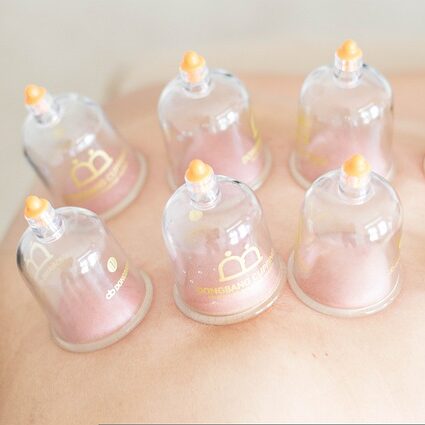 Cupping Therapy