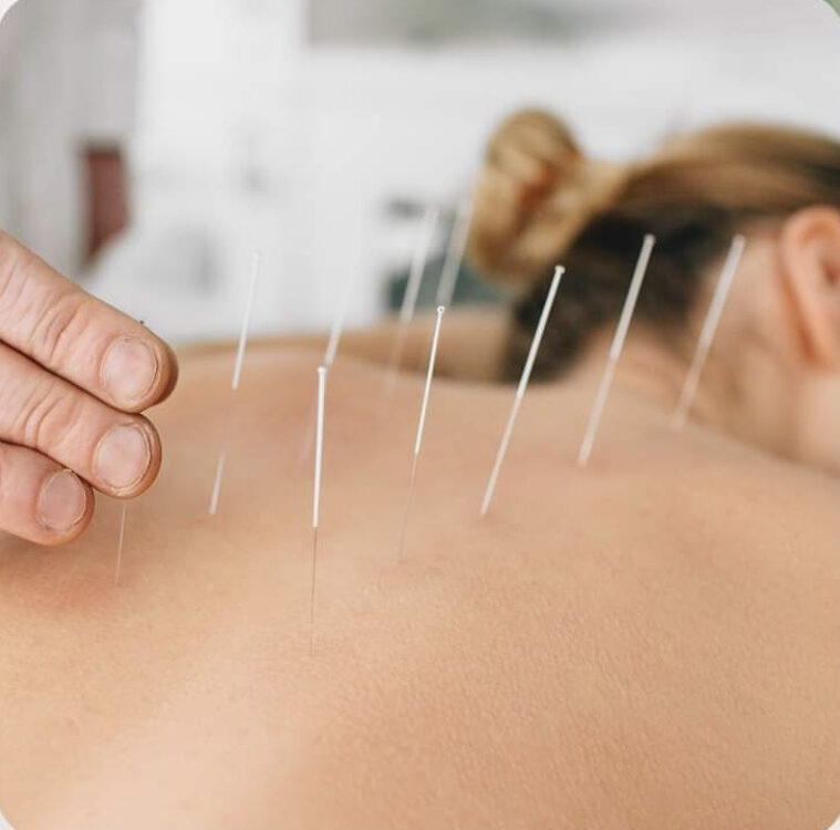 Acupuncture treatments in Naniamo, BC